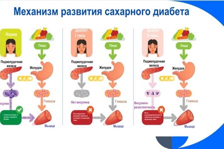 Механизм развития сахарного диабета первого типа.